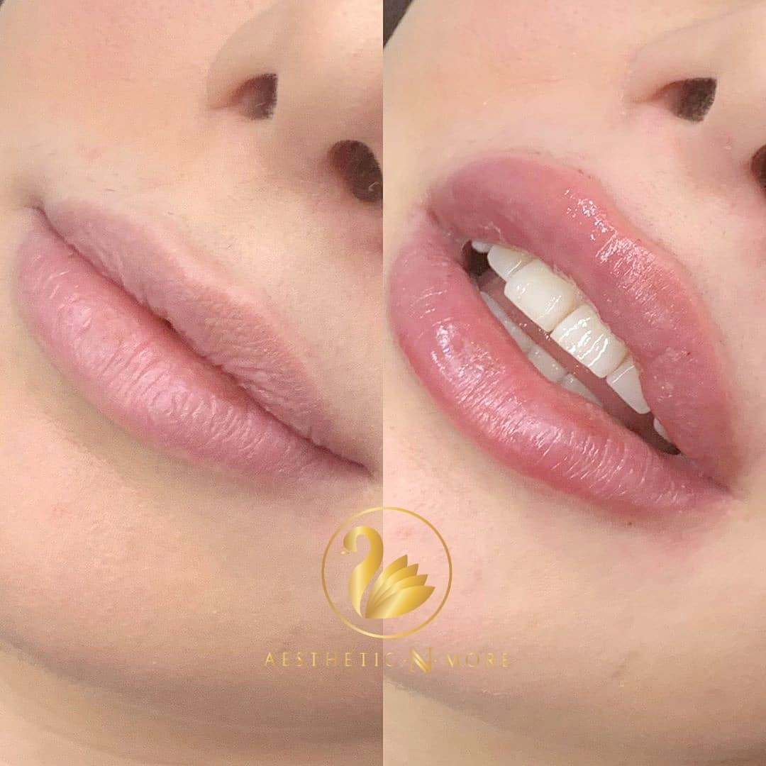 Lippenunterspritzung mit Hyaluron